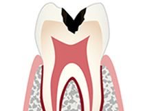 「C2」象牙質までの虫歯進行